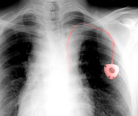 Chest xray showing PowerPort